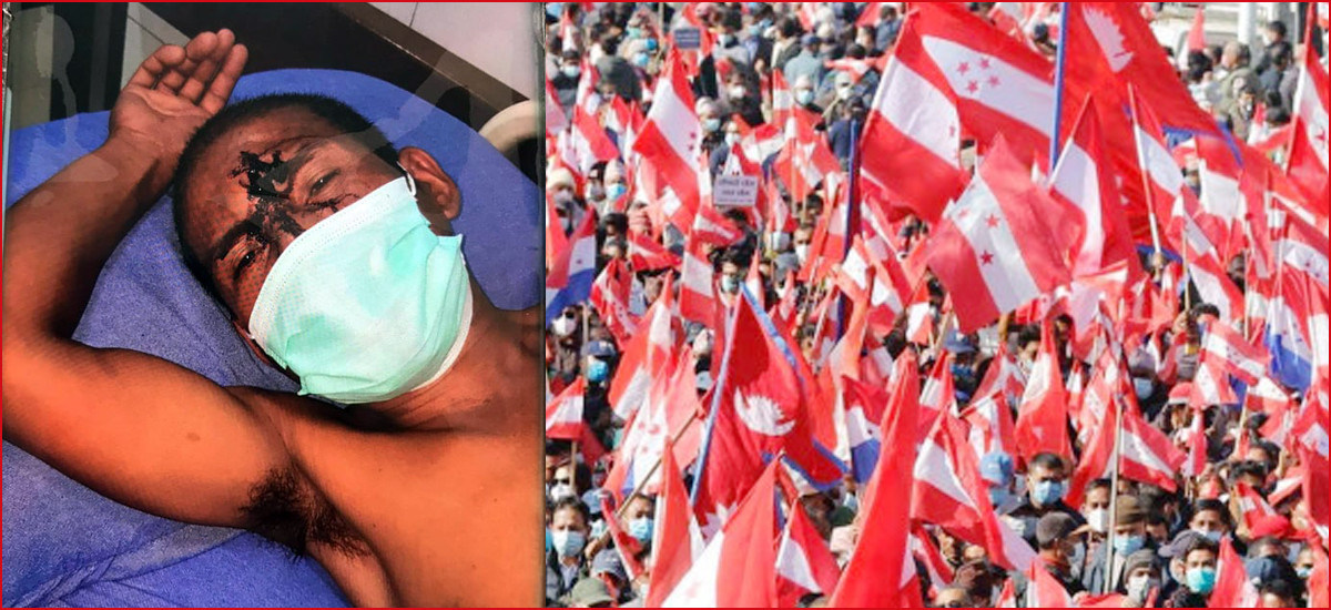 एमाले कार्यकर्ताले गरे कांग्रेस नेतामाथि सांघातिक आक्रमण, महर्जनको खबरदारीपछि मुद्दा दर्ता